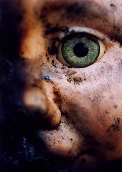 visage d'un enfant brûlé